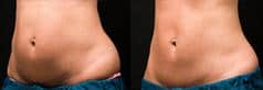 Before and after one CoolSculpting Treatment, 60 days post.