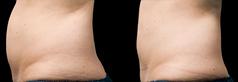 Before and after one CoolSculpting Treatment, 120 days post.