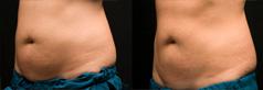 Before and after one CoolSculpting Treatment to abdomen, 120 days after.