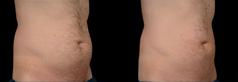 Before and after one CoolSculpting Treatment, 60 days post.