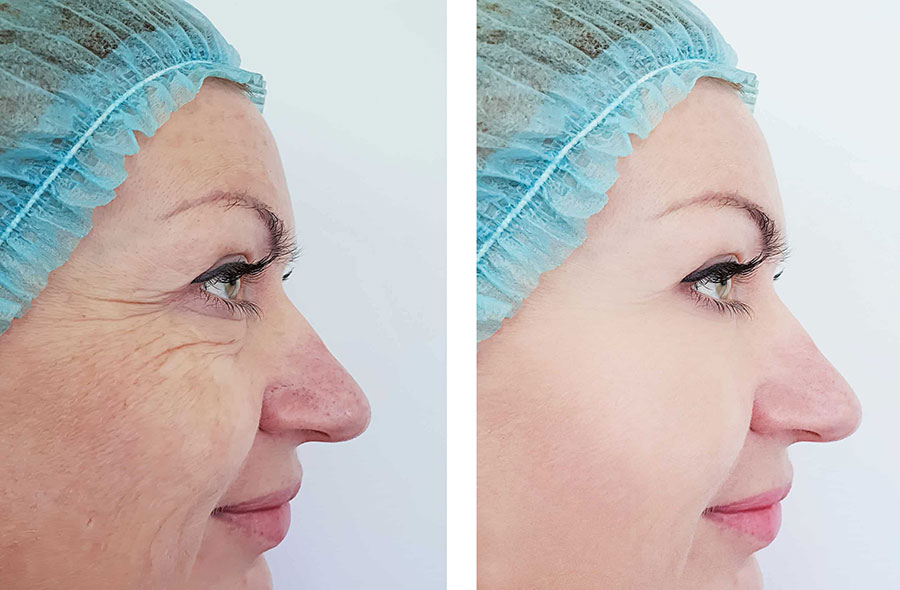 Before and after photos showing a woman's face with lines and wrinkles around the eyes and cheeks before and smooth, wrinkle-free skin after PDO threads in Colorado.