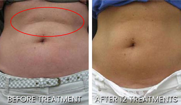 CoolSculpting - The New Gold Standard