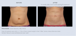 Can CoolSculpting help with stubborn fat?