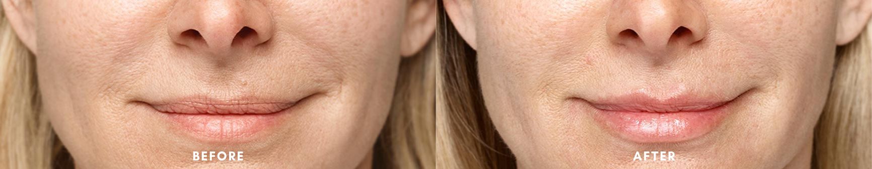 Amazing before and after result from restylane lip filler treatment at Hollywood Body Laser Center