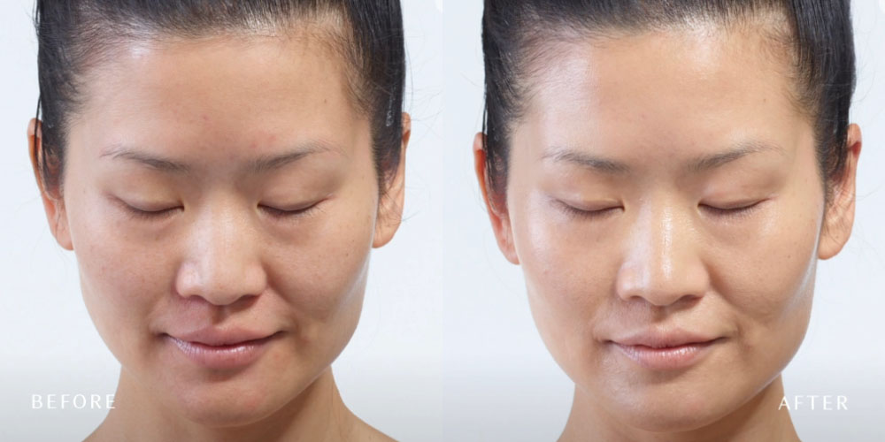 Before and after photos of DiamondGlow treatment, showing a clearer and tighter skin.