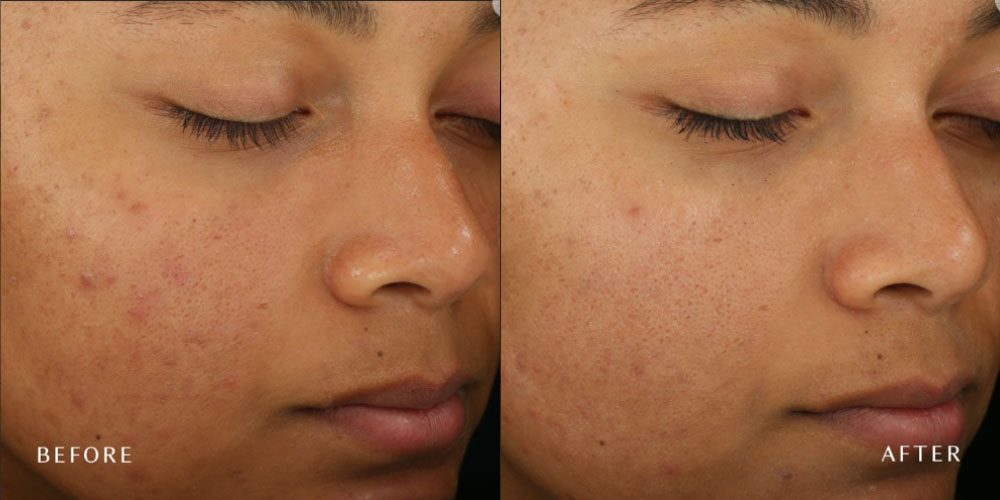 A closeup before and after photo of a woman's face showing a clearer skin after DiamondGlow treatments.