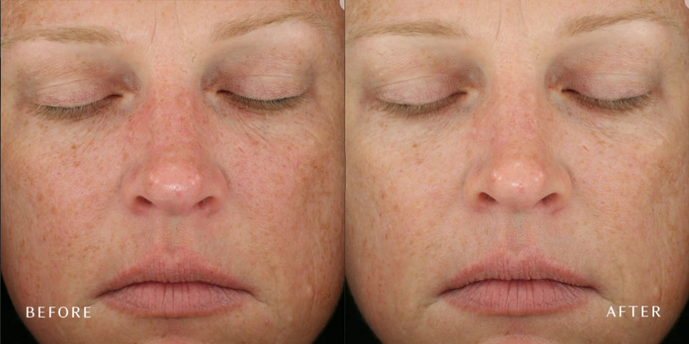 A closeup before and after photo of a woman's face showing a clearer and brighter skin from DiamondGlow treatments.