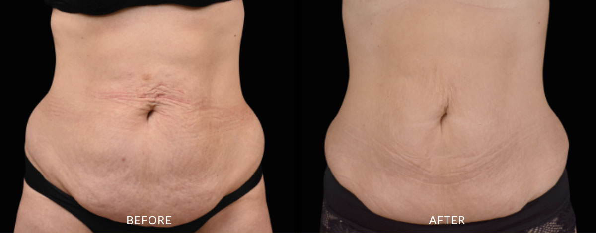 Coolsculpting Elite before and after photo showing a reduced sagging fat in the abdomen of a woman.
