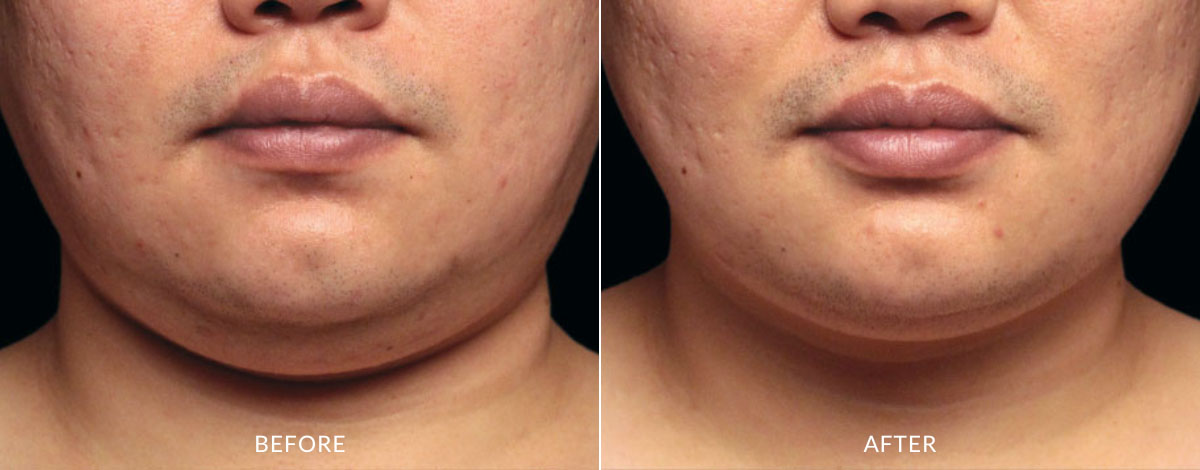 Coolsculpting Elite before and after photo showing a reduced fat in the area that connects the chin and neck of a man.