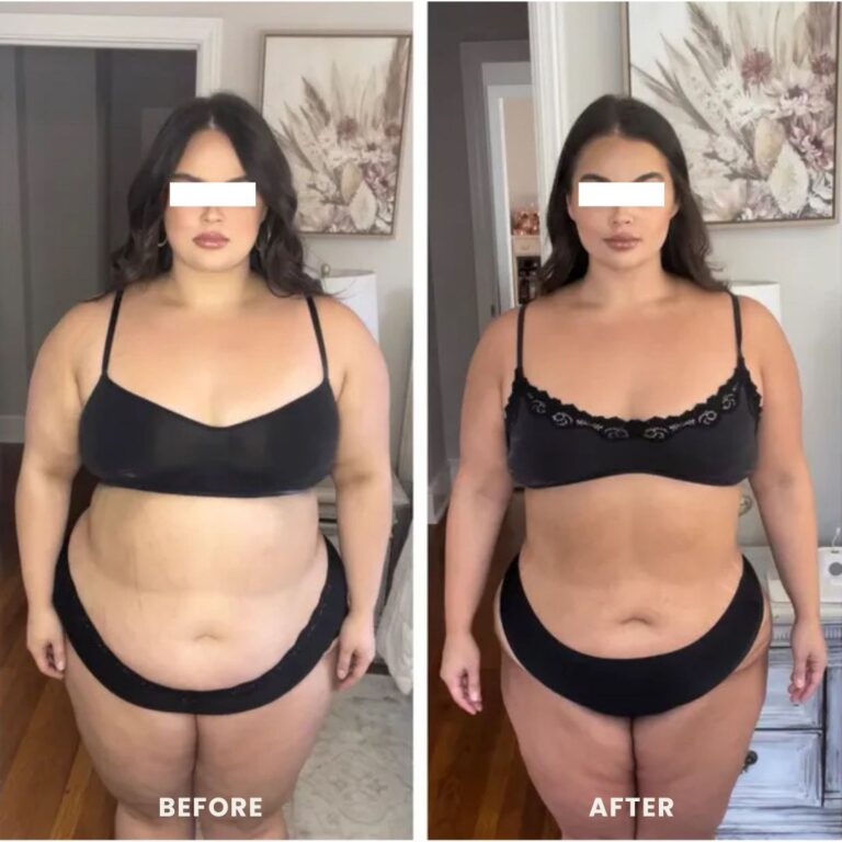 weight loss injections before and after of a woman showing a reduced body fat.