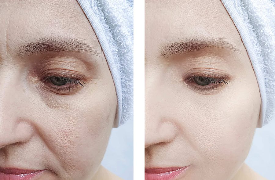 Before and after photos of a woman's face showing wrinkled, sagging skin before and smooth, ageless skin after PDO thread treatment in Colorado.